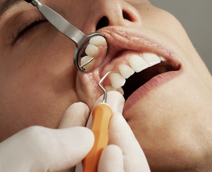 dental_service_crowns_bridges
